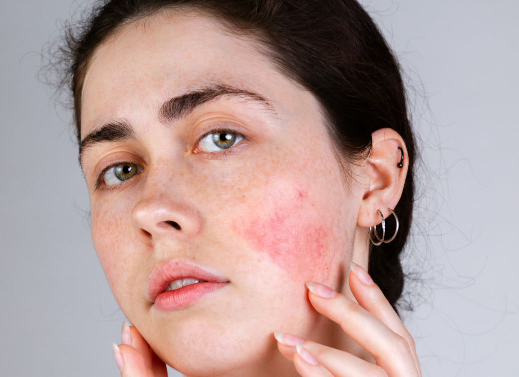 Should I Moisturise Rosacea? Balmonds