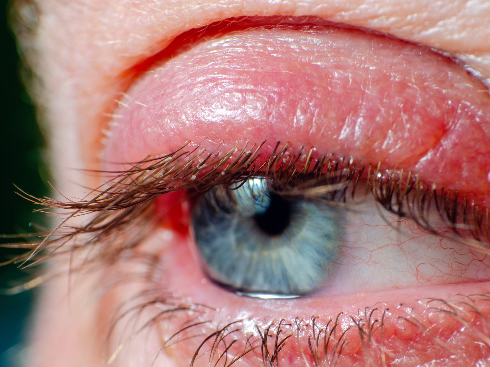 Does Blepharitis Go Away On Its Own?  Balmonds