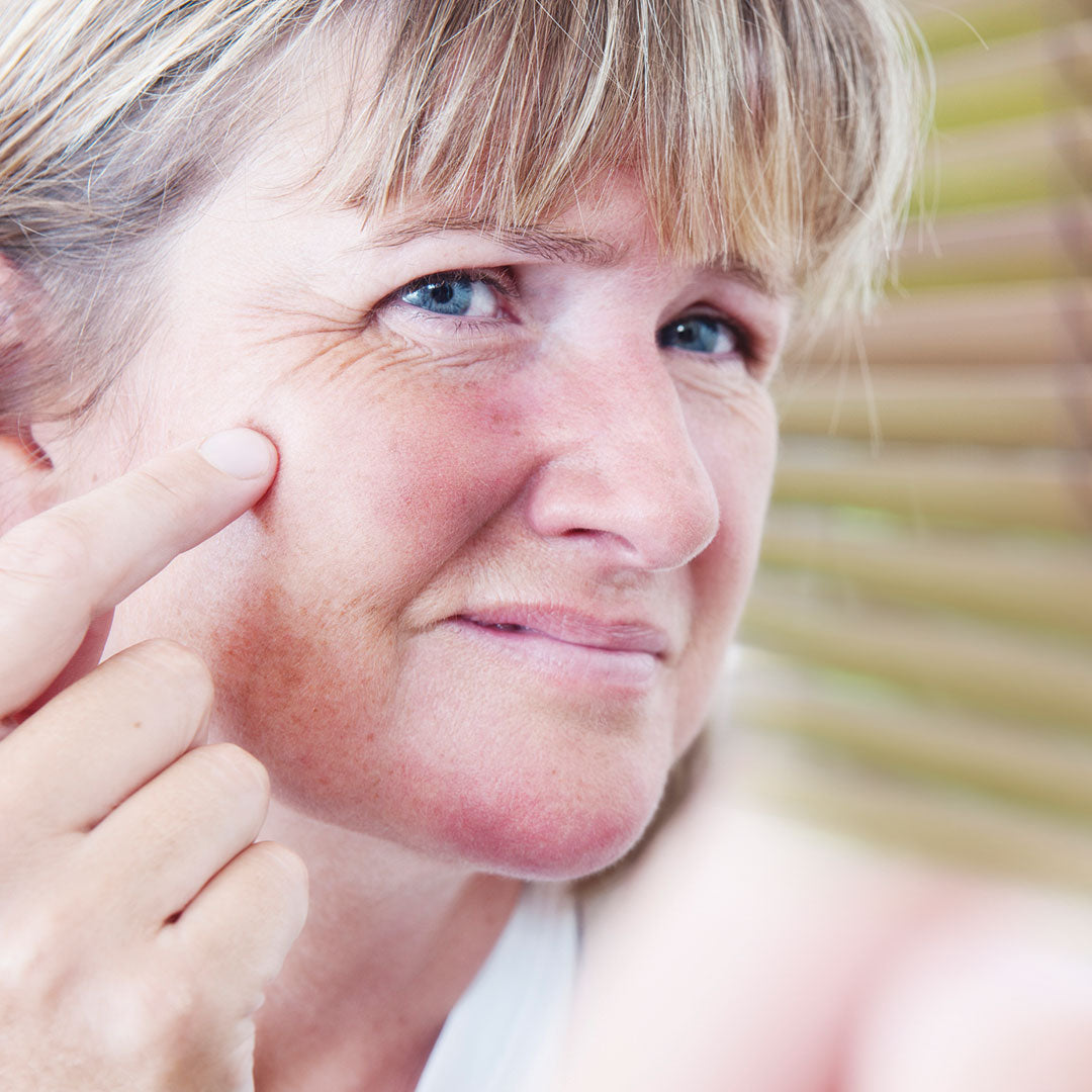 Why Is My Face Red & Blotchy? Balmonds