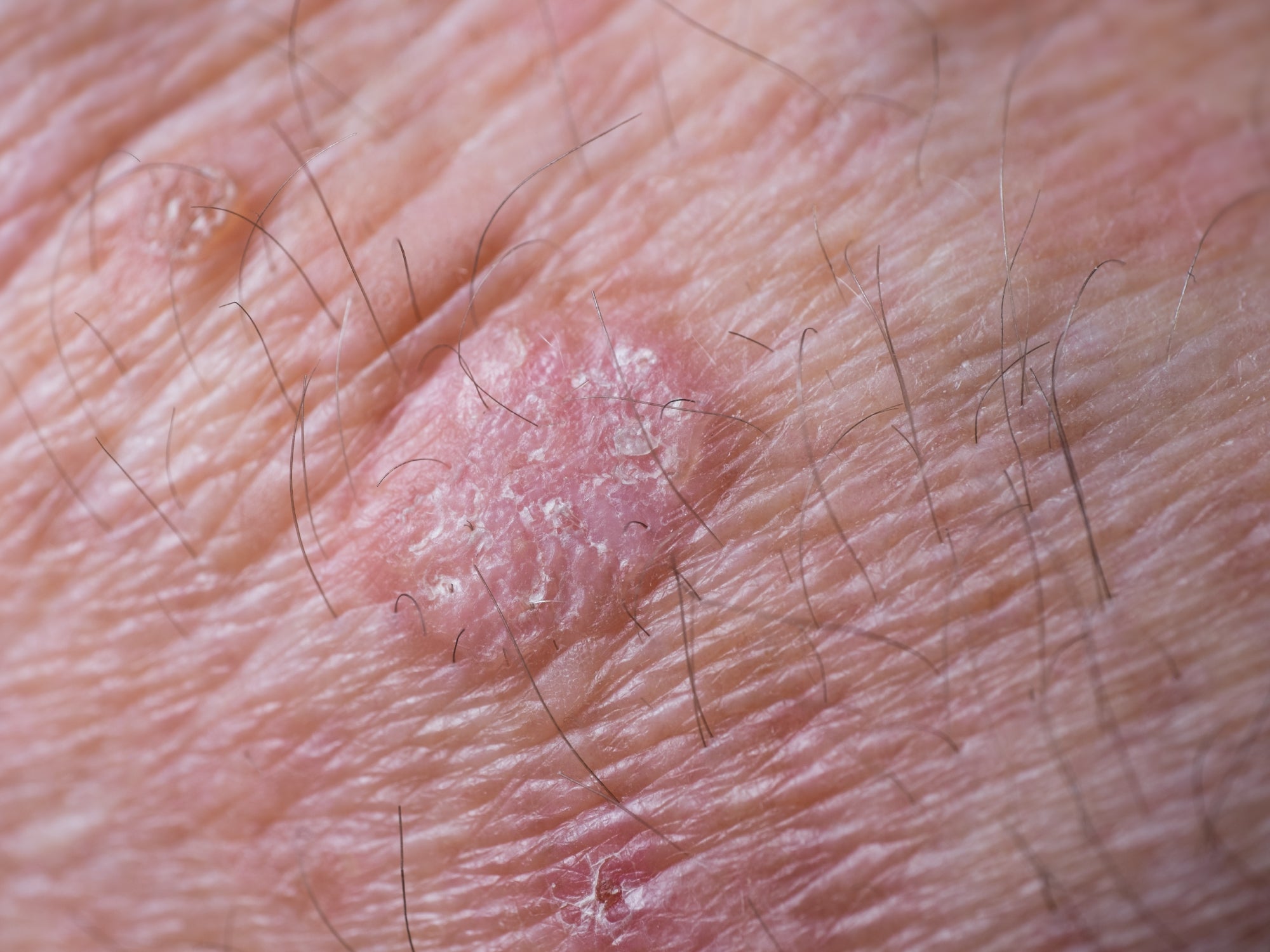 Should Actinic Keratosis Be Removed Balmonds