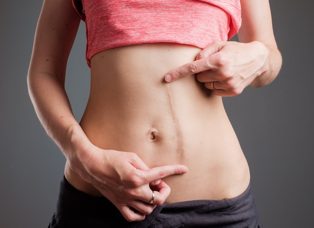 A scar on an abdomen