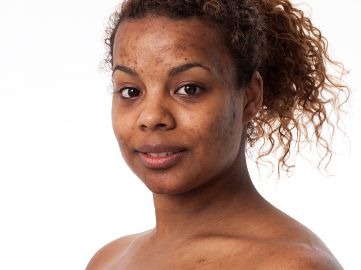 What Does Post-Inflammatory Hyperpigmentation Look Like?