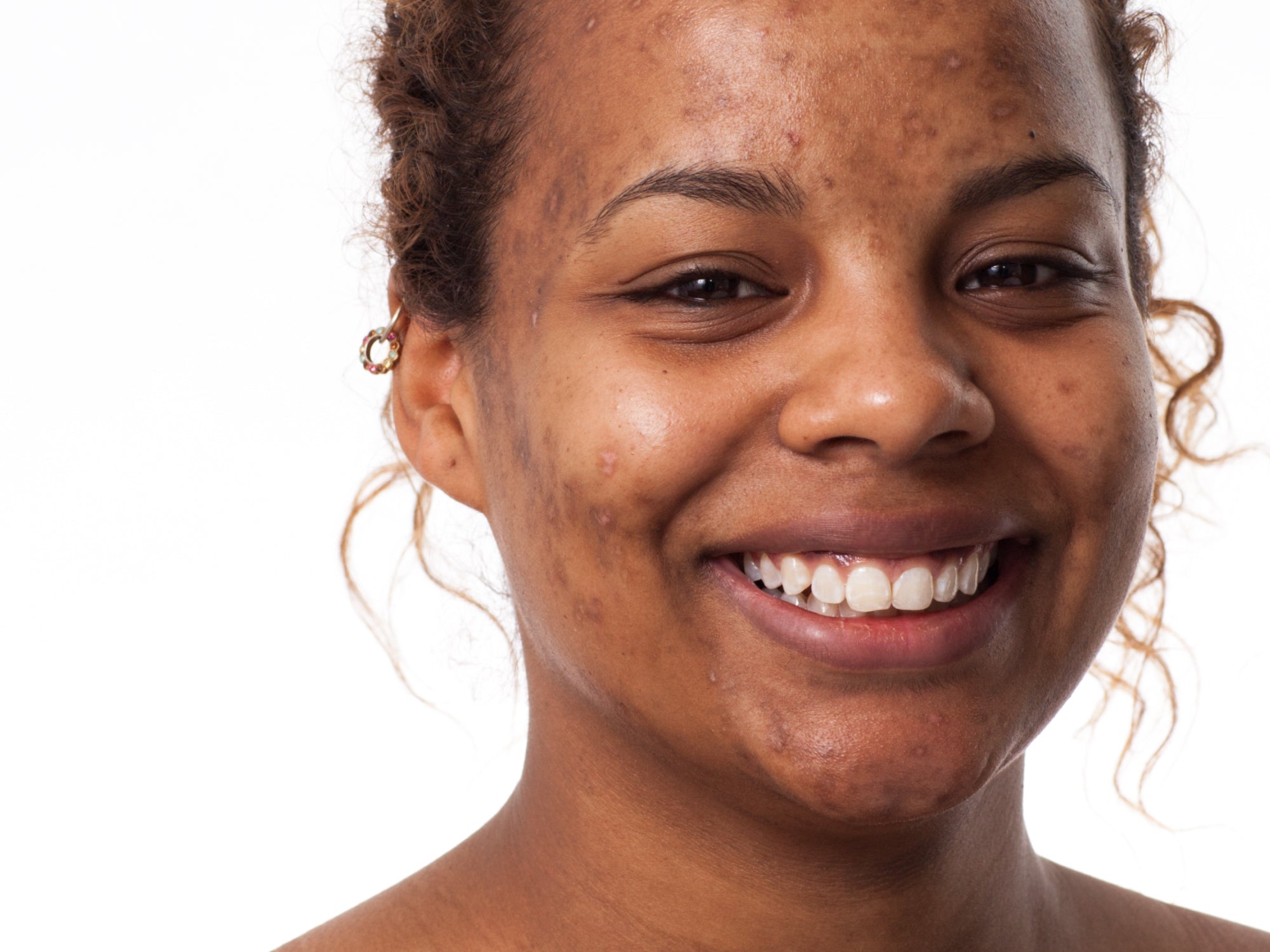 How To Get Rid Of Post-Inflammatory Hyperpigmentation