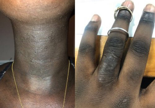 Post-Inflammatory Hyperpigmentation: My Flaky Relationship With My Skin Disorder