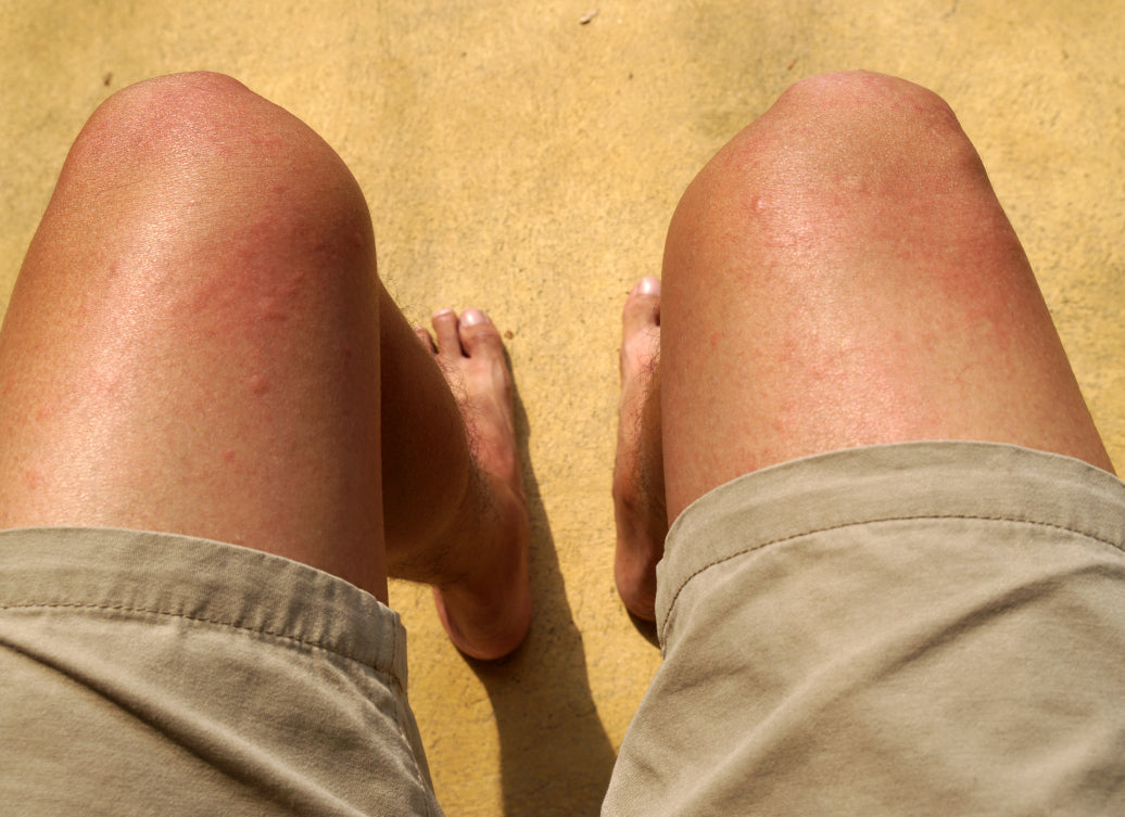 Does Chlorine Rash Spread?