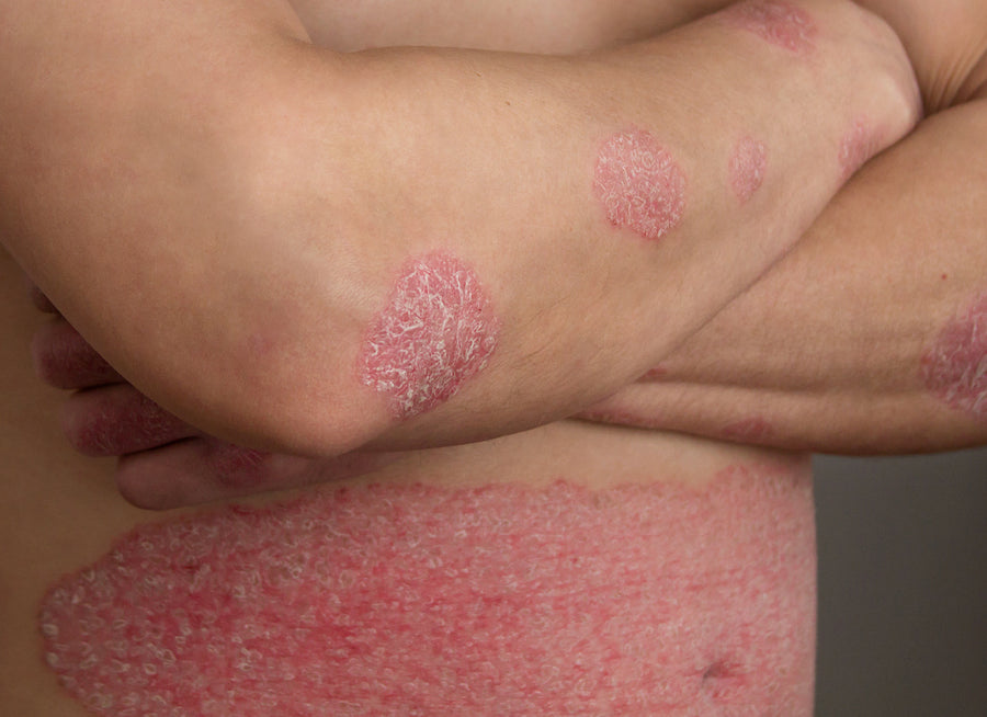 Does Psoriasis Have A Smell?