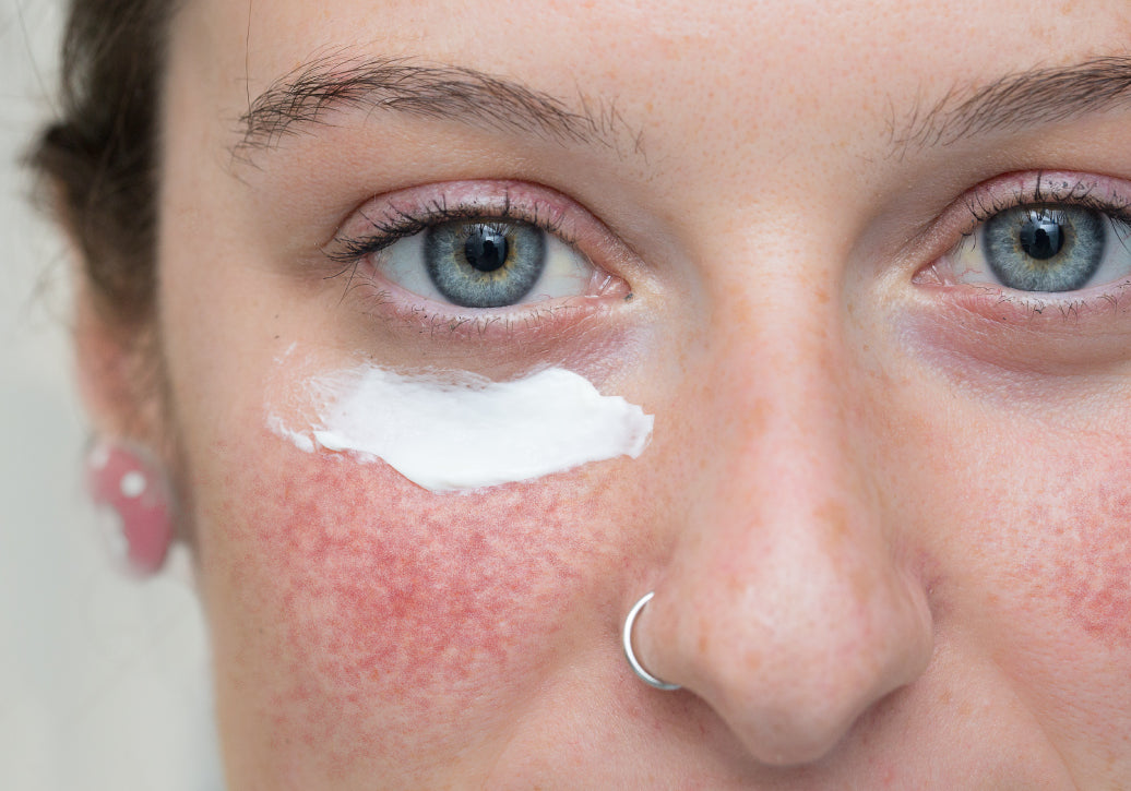 Does Rosacea Ever Go Away?