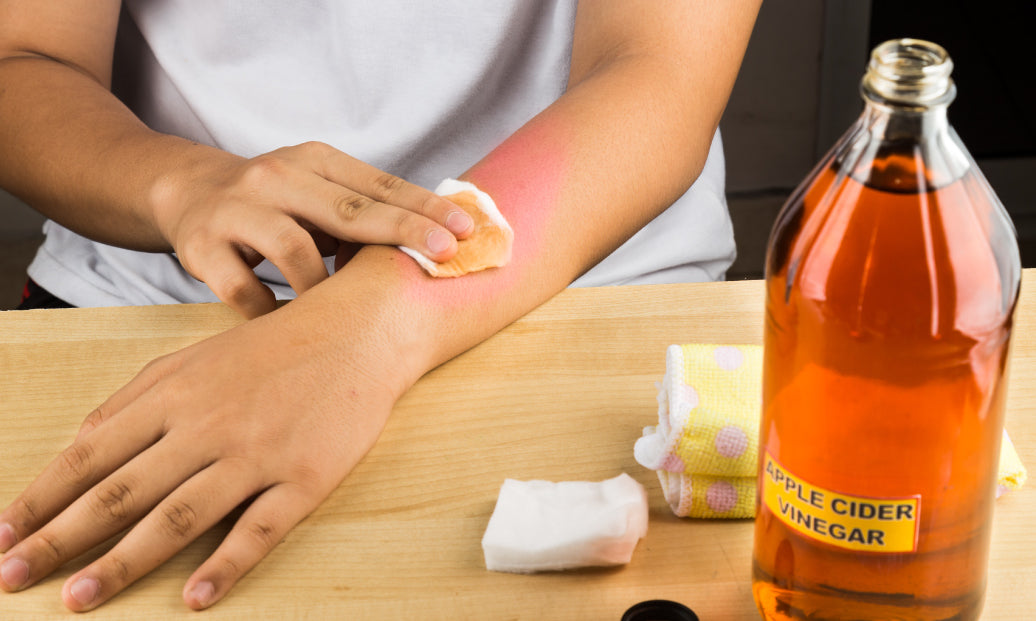 Does Vinegar Kill Psoriasis?