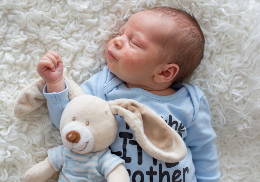 A baby with eczema on cheeks