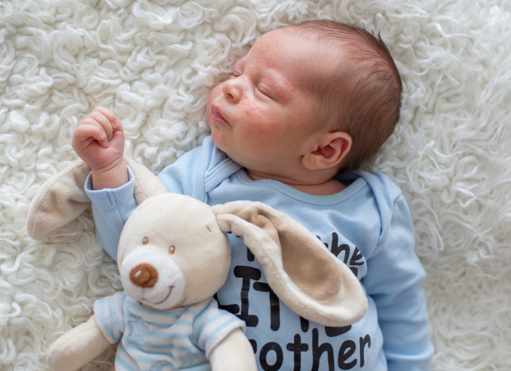 A baby with eczema on cheeks