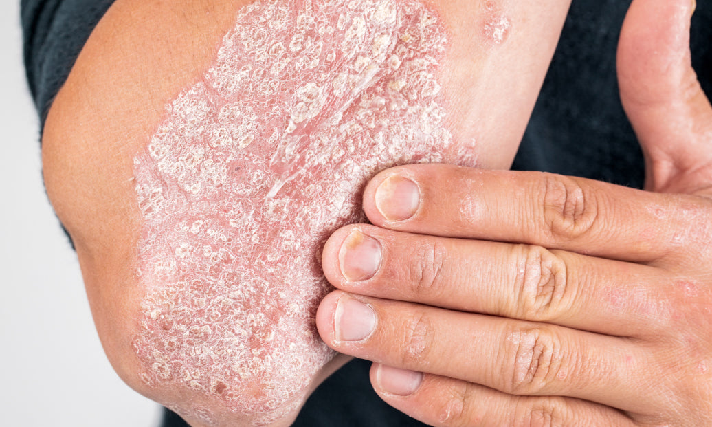 How Do You Clear Up Psoriasis?