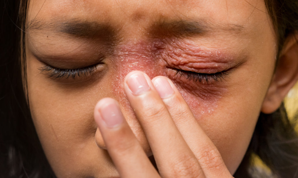 How Do You Treat Periocular Dermatitis?