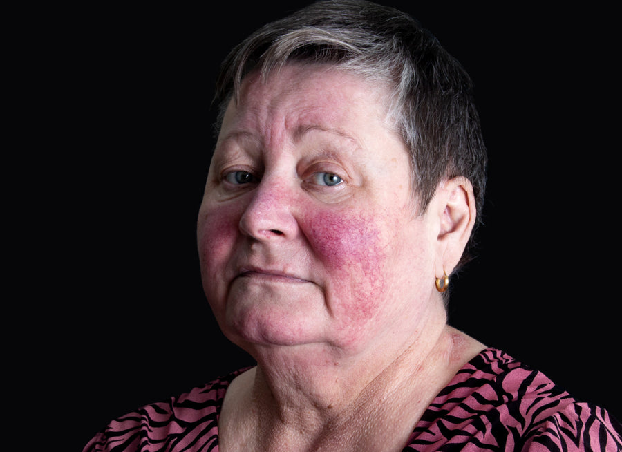 How Serious Is Rosacea?