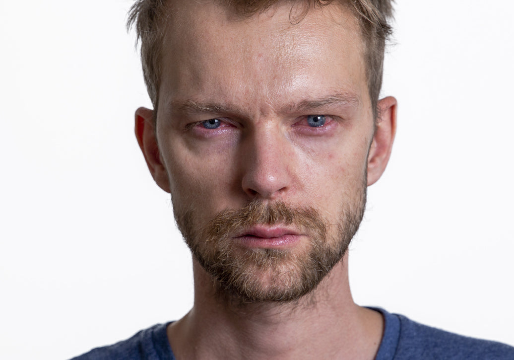 Is Periocular Dermatitis Contagious?