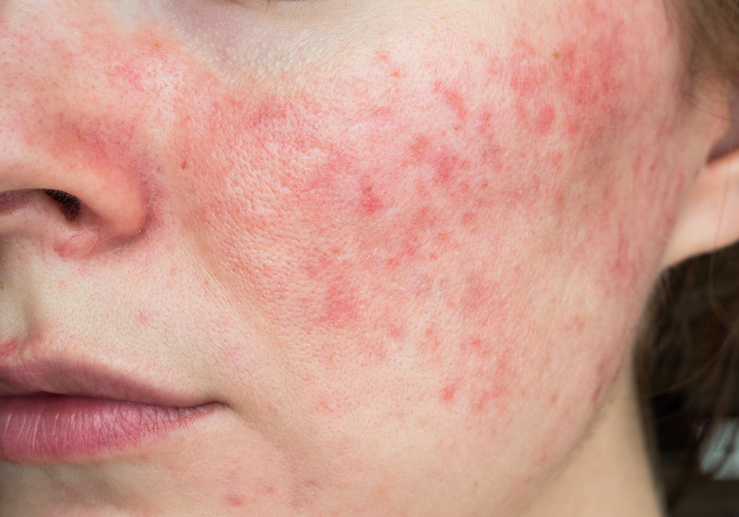 Is Rosacea An Autoimmune Condition?