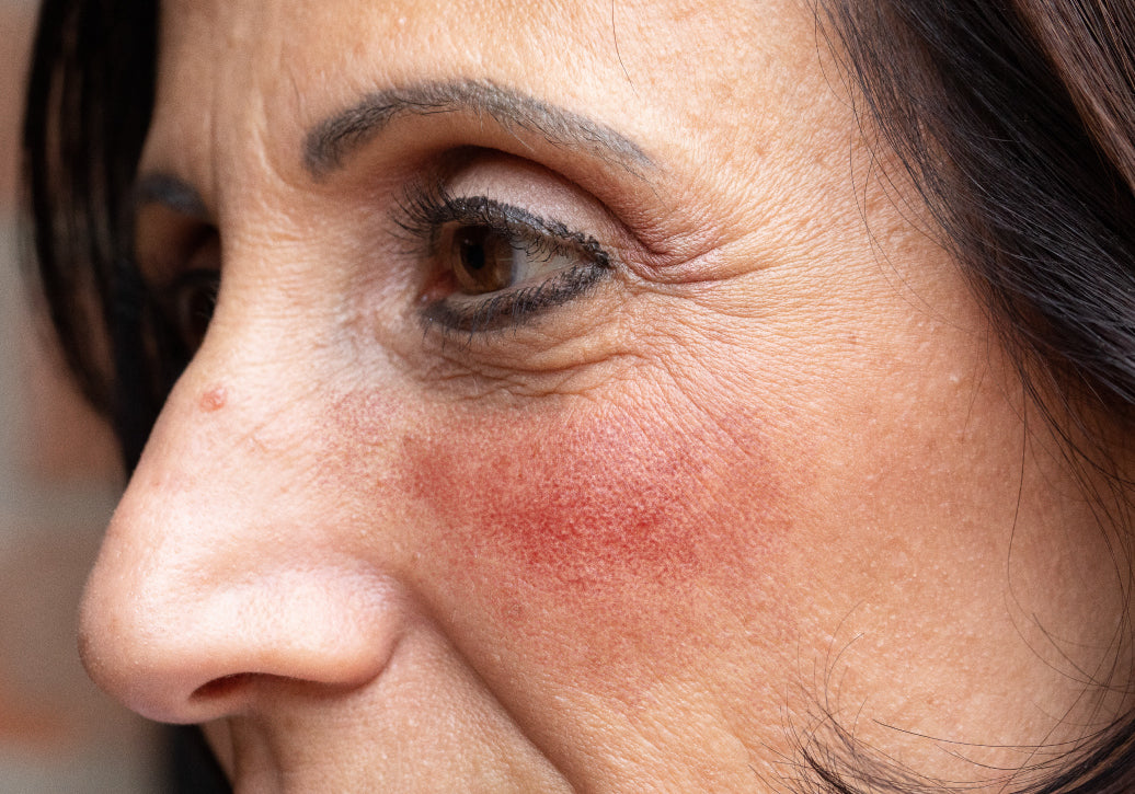 Is Rosacea Hormone Related?