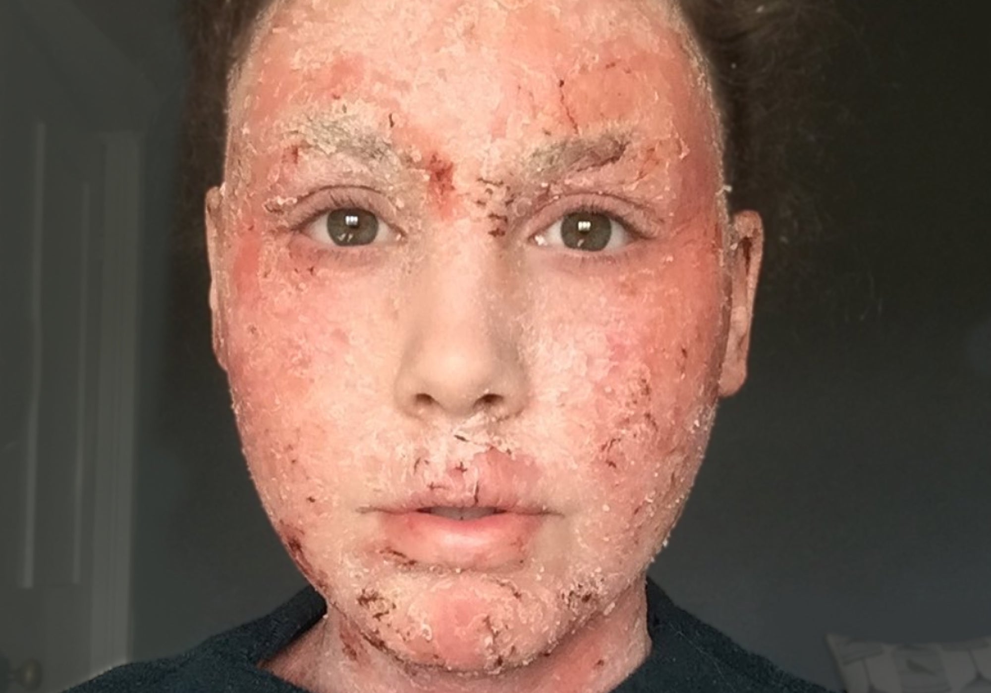 NMT: No Moisture Treatment Guide For Topical Steroid Withdrawal