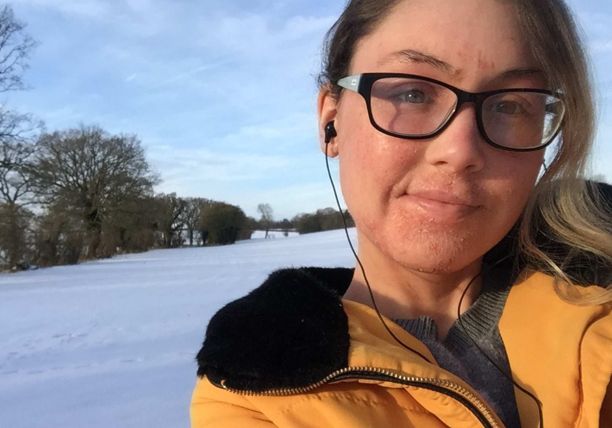 How To Get Through Topical Steroid Withdrawl (TSW): Winter Skincare
