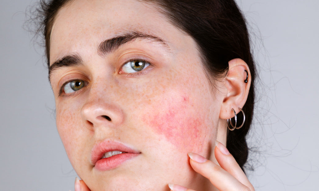 Should I Moisturise Rosacea?