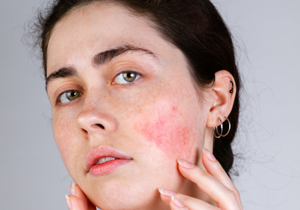 Should I Moisturise Rosacea?