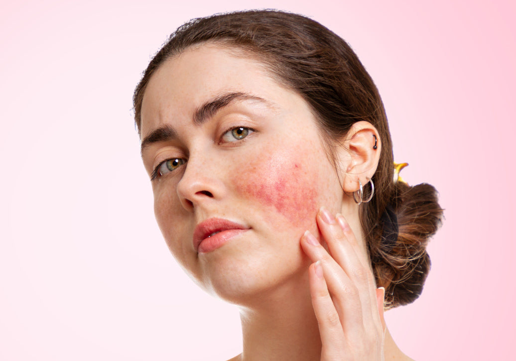 What Are The Stages of Rosacea?