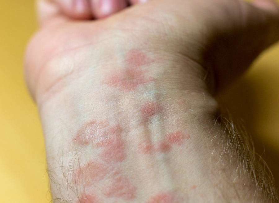 What Does Psoriasis Look Like When It Starts?