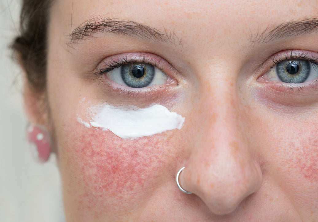 What’s The Best Moisturiser For Rosacea?