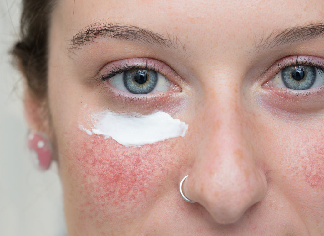 What’s The Best Moisturiser For Rosacea?