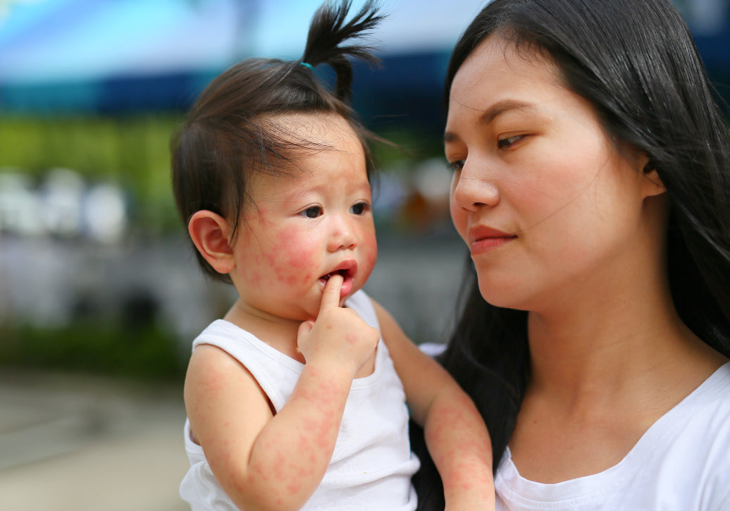 Mother holding child with eczema