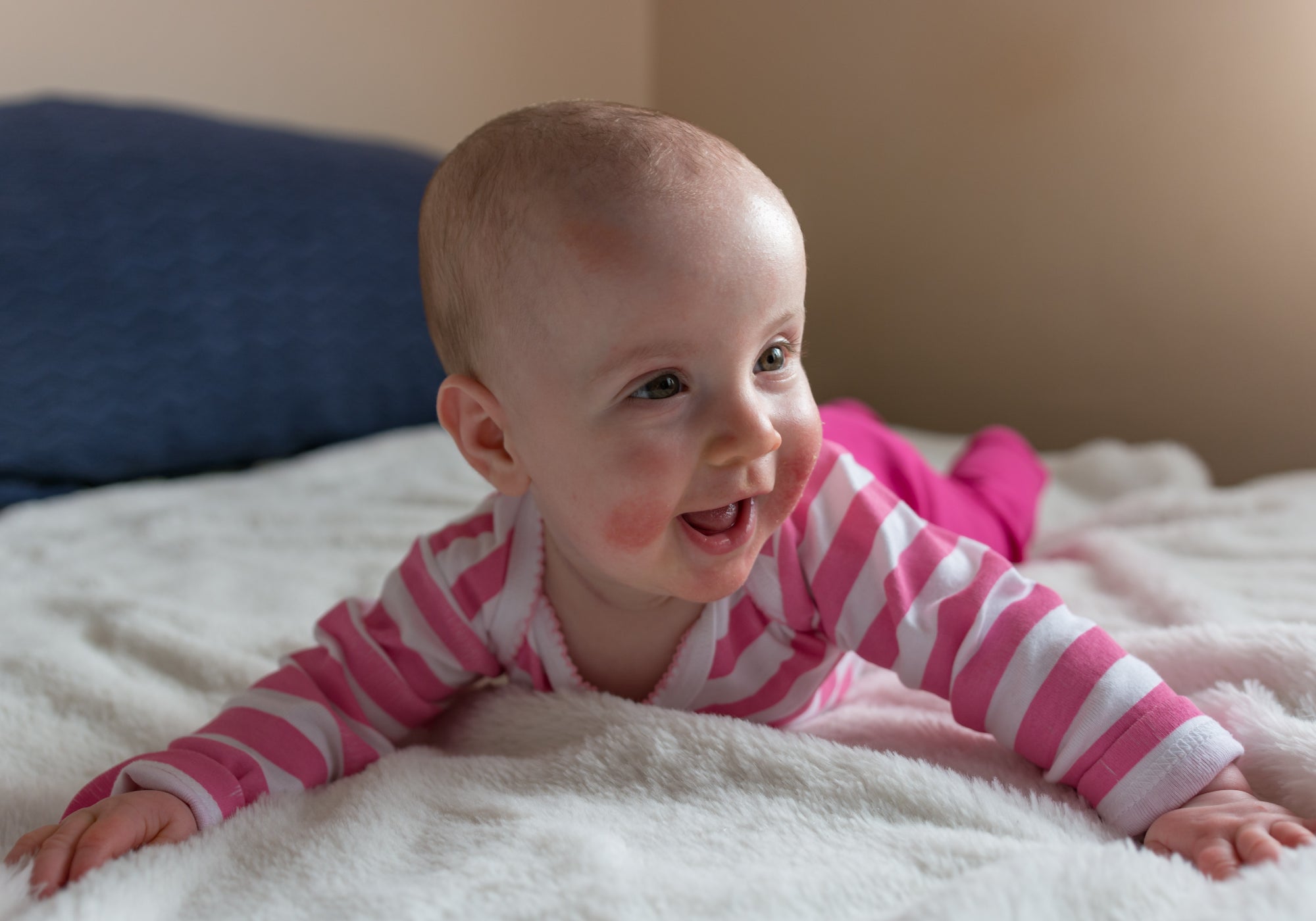 How To Treat Perioral Dermatitis In Babies