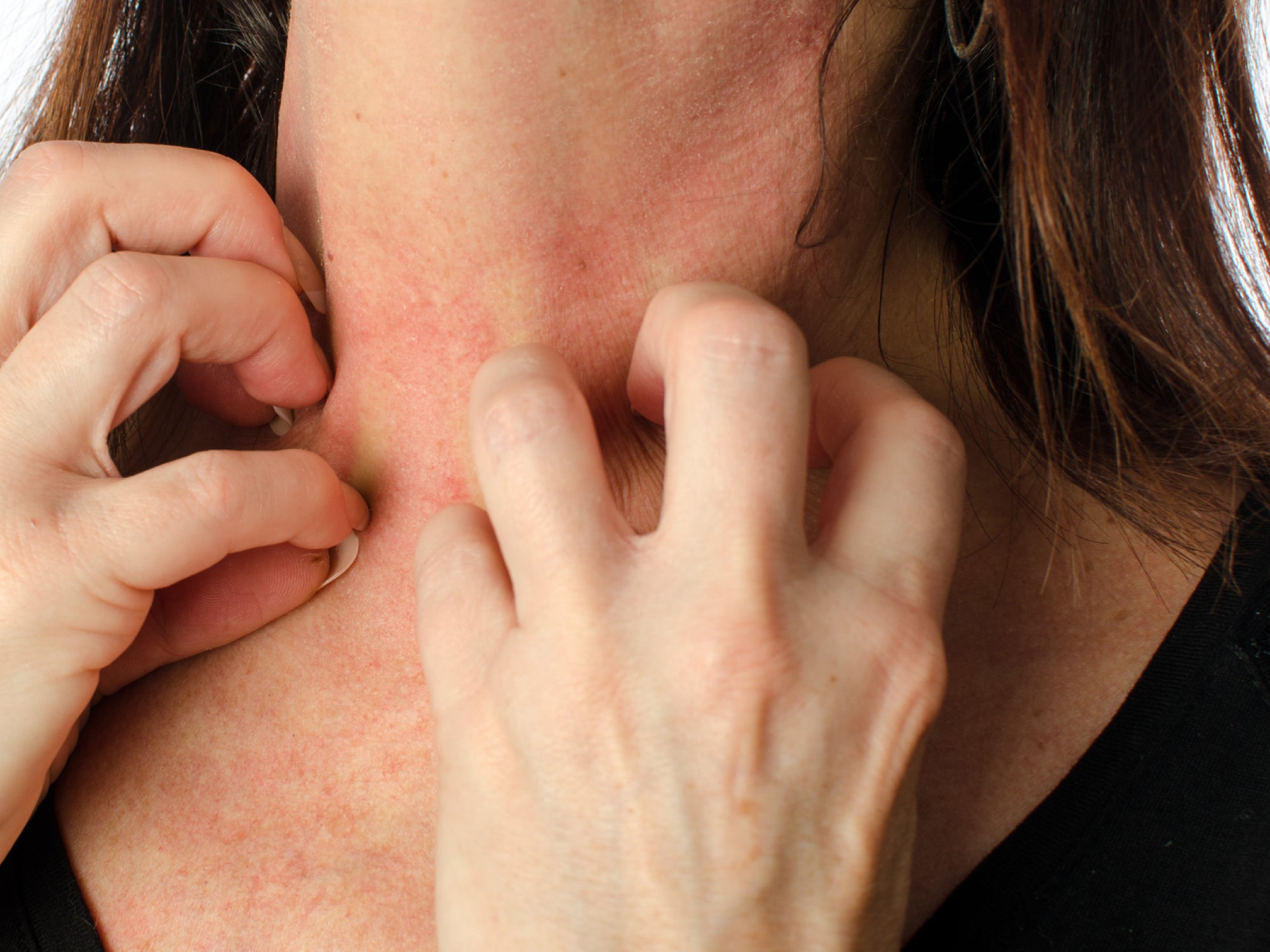 What Does Diabetic Skin Rash Look Like?