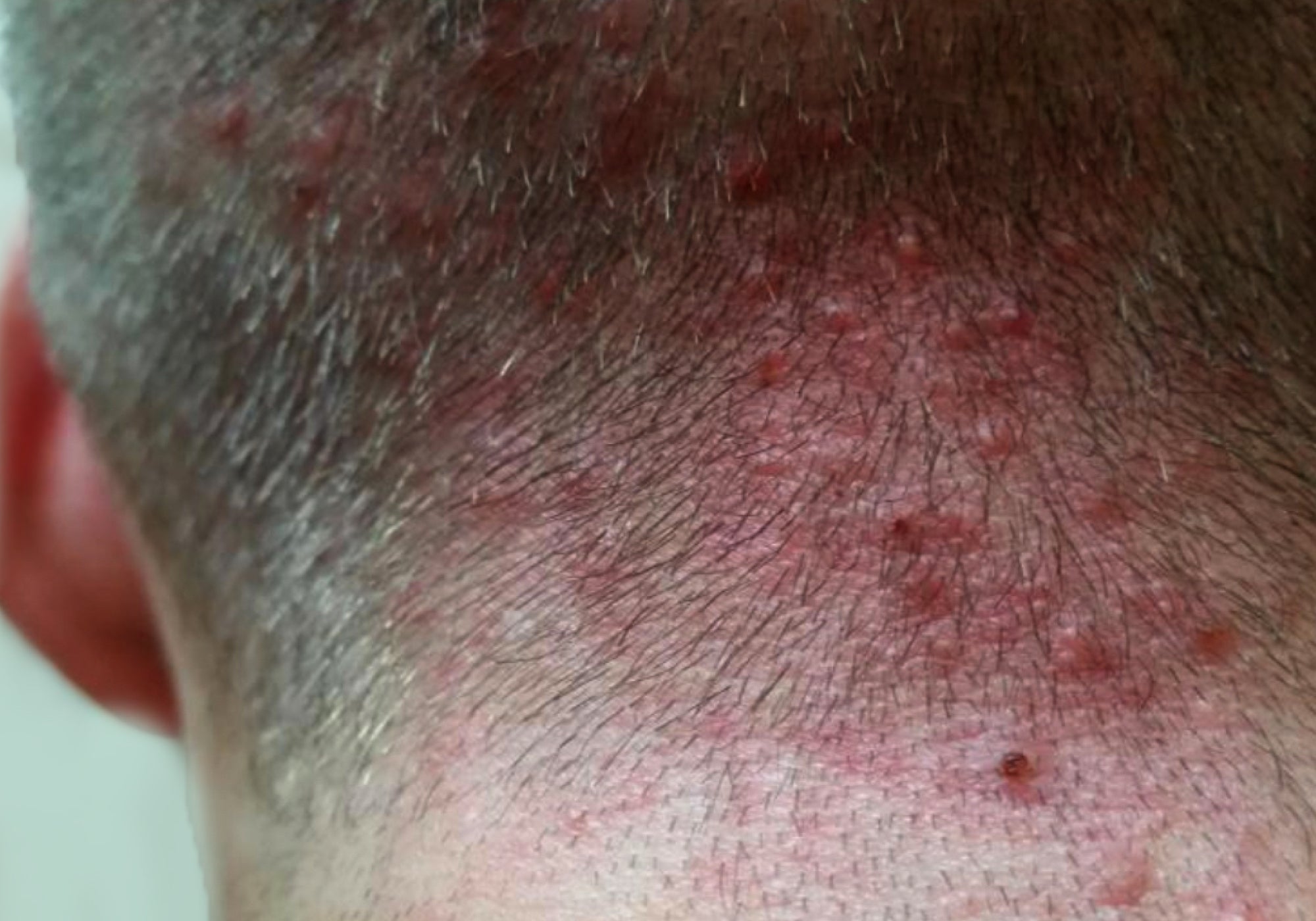 What Does Scalp Folliculitis Look Like?