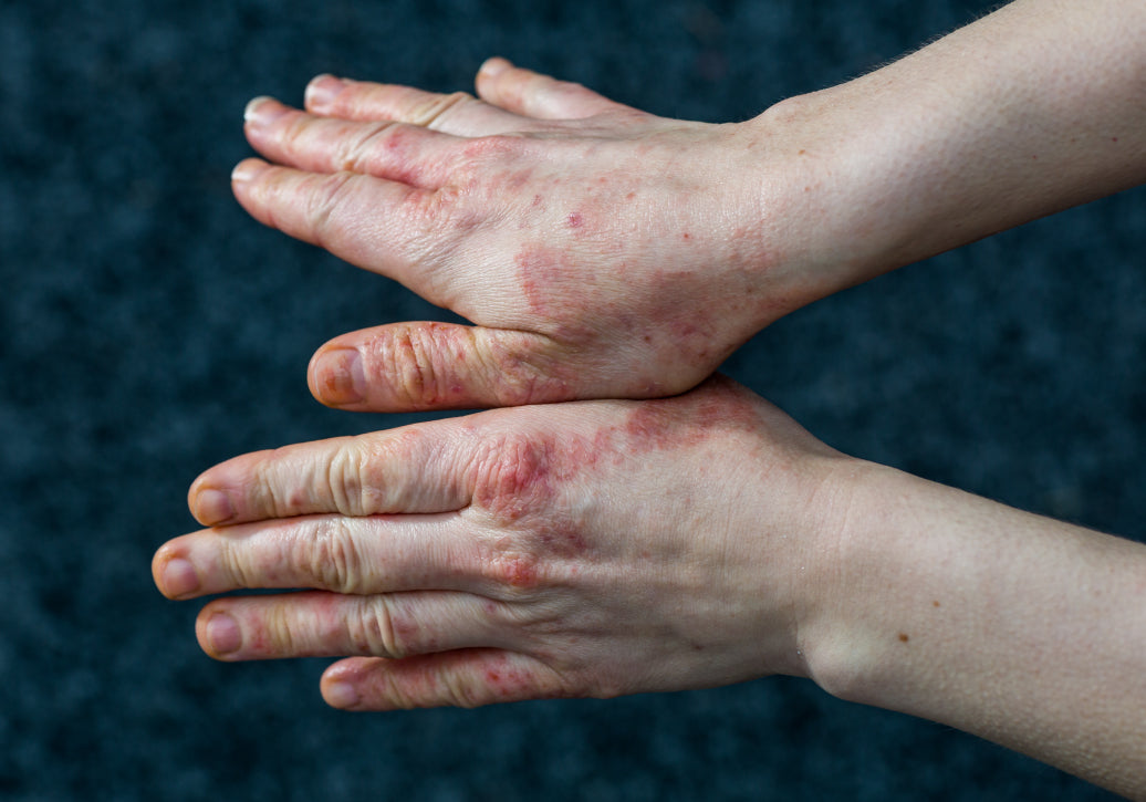 What Cures Eczema Fast?!