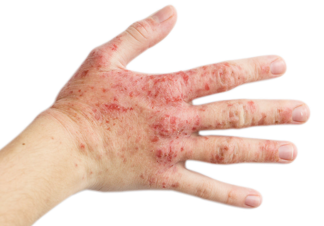 What’s The Main Cause Of Eczema?