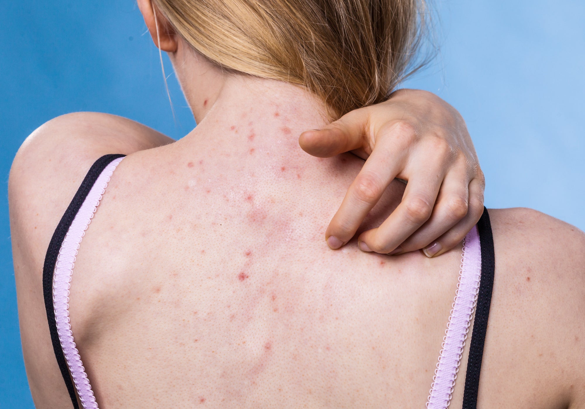 Can Acne Look Like A Rash?