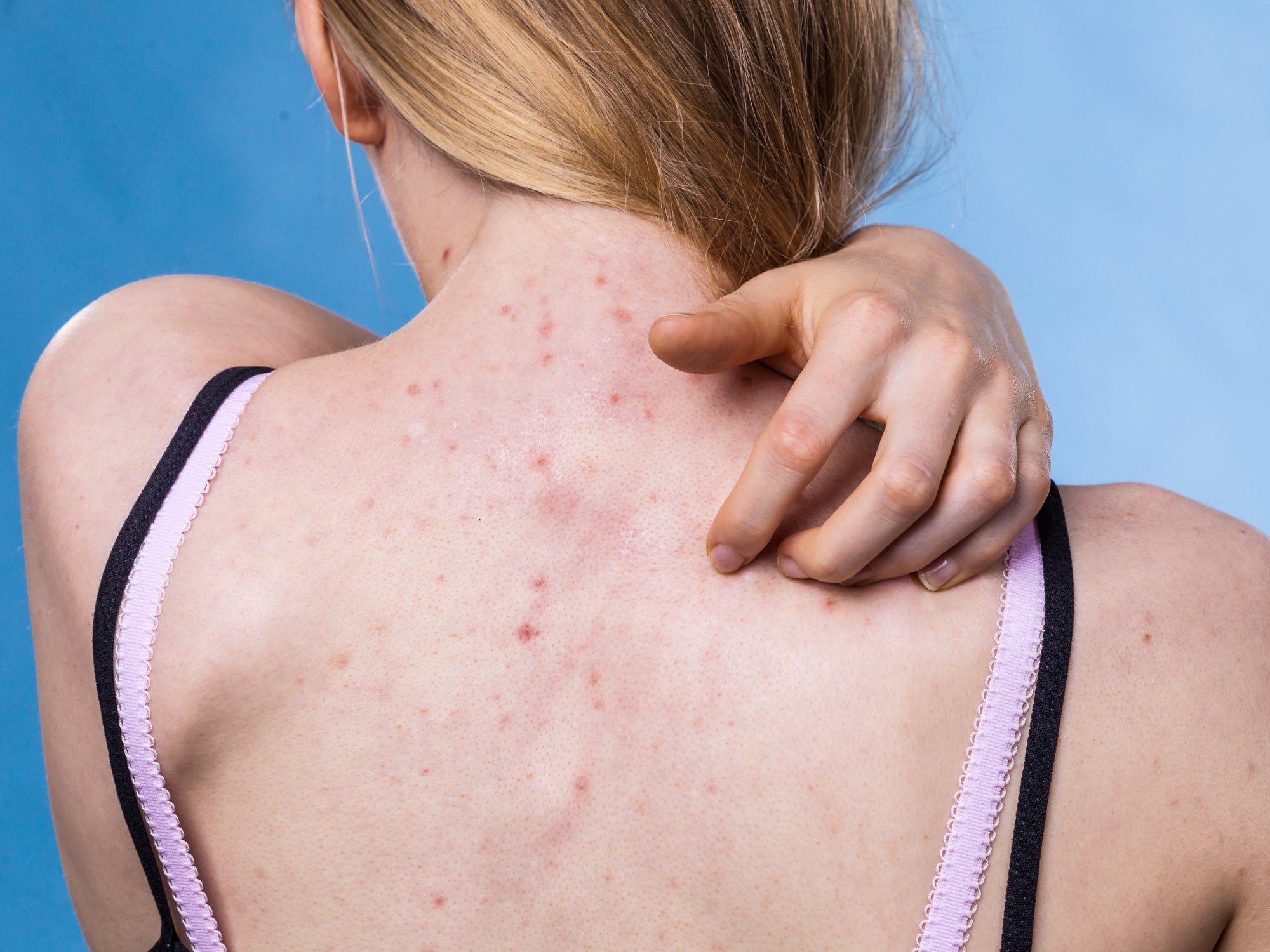 Can Acne Look Like A Rash?