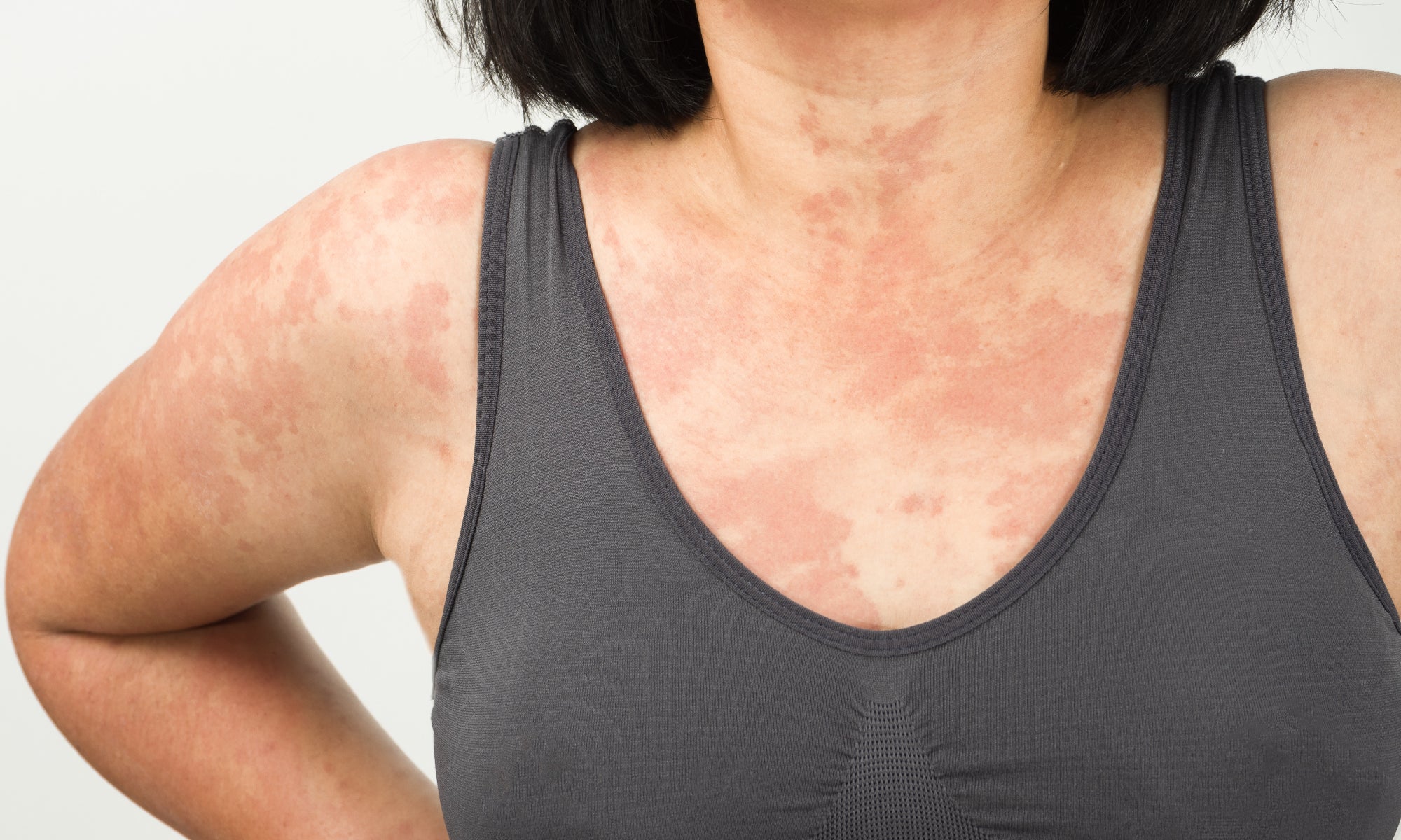 Can Anxiety Cause Rashes?