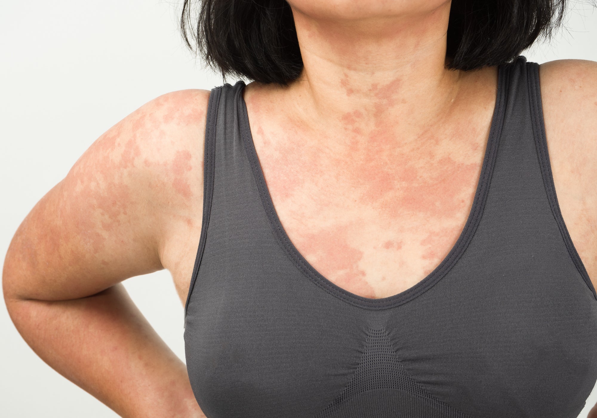 Can Anxiety Cause Rashes?