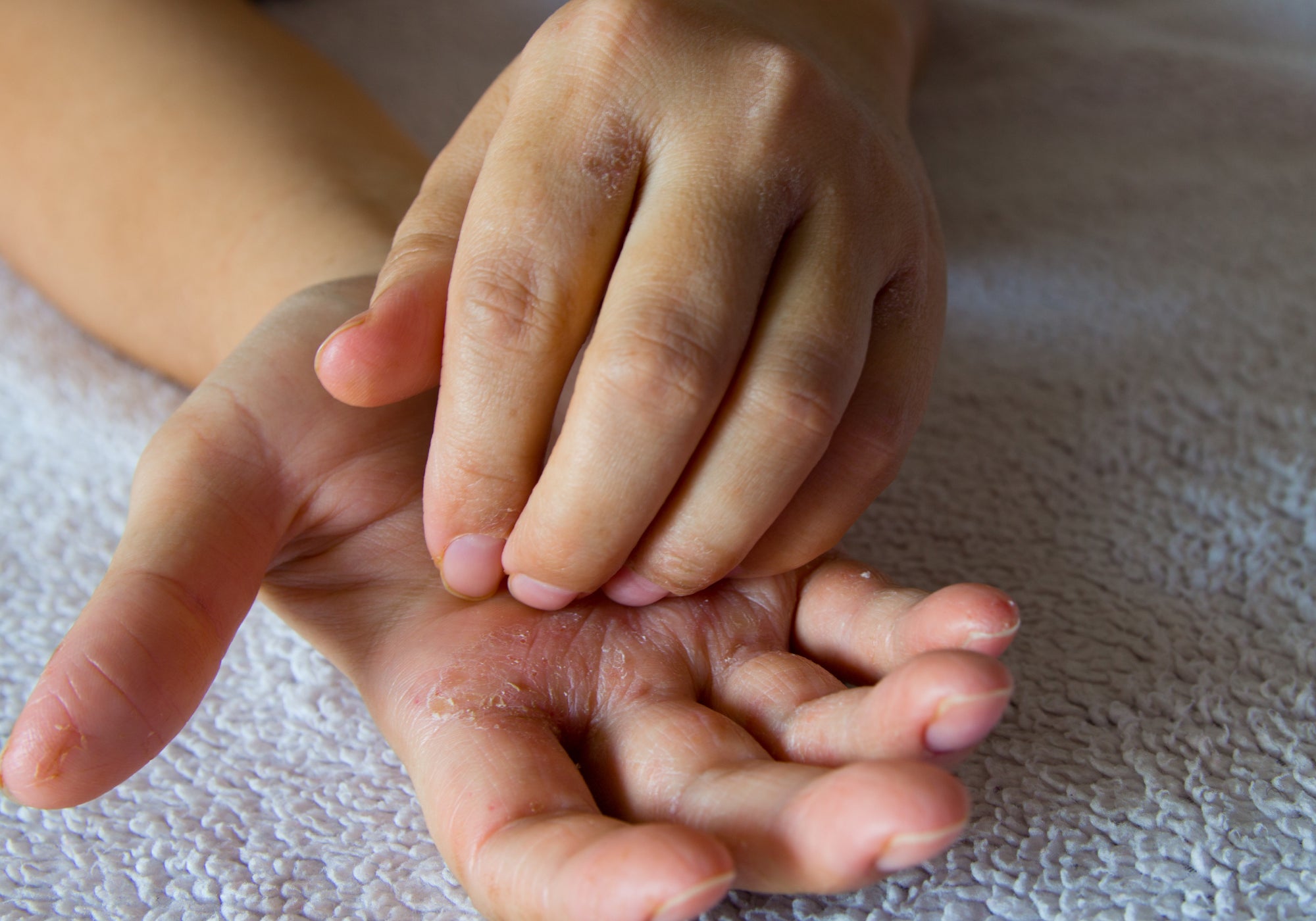Can Hand Sanitiser Make Your Hands Itch?
