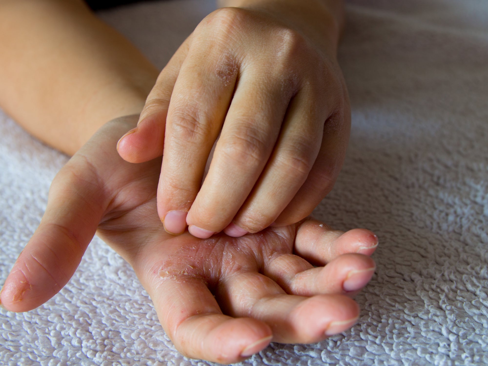 Can Hand Sanitiser Make Your Hands Itch?