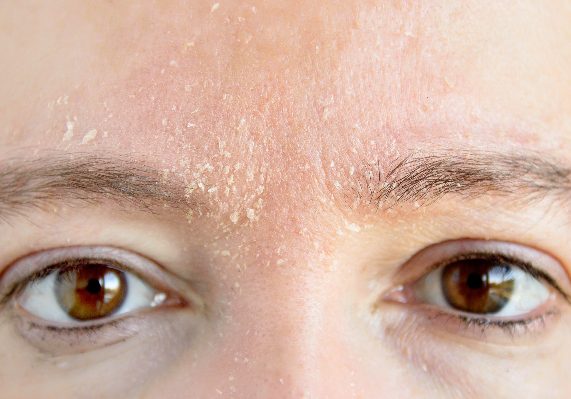 How Do I Fix Dry Skin On My Face?