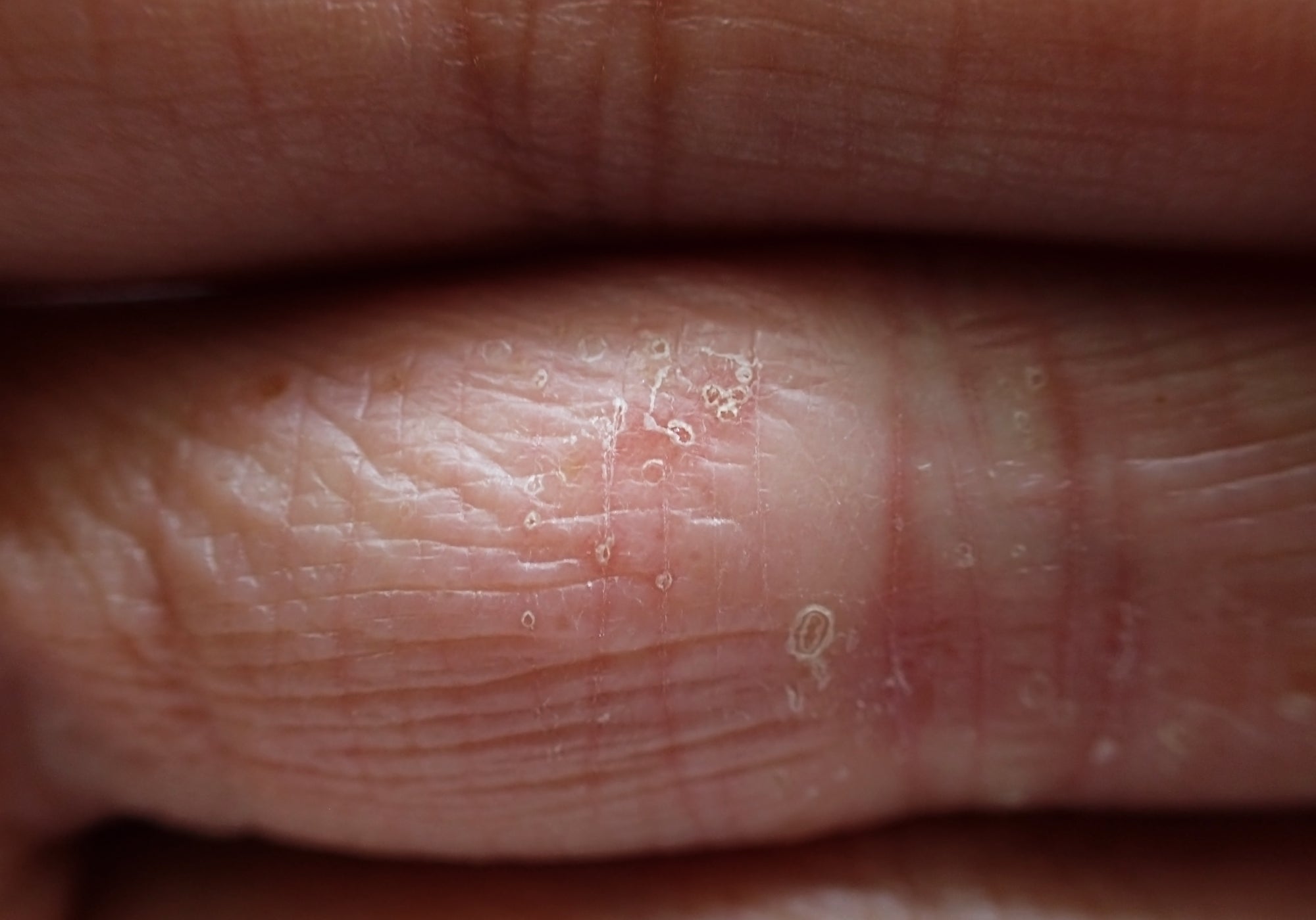 How Do You Soothe Pompholyx?