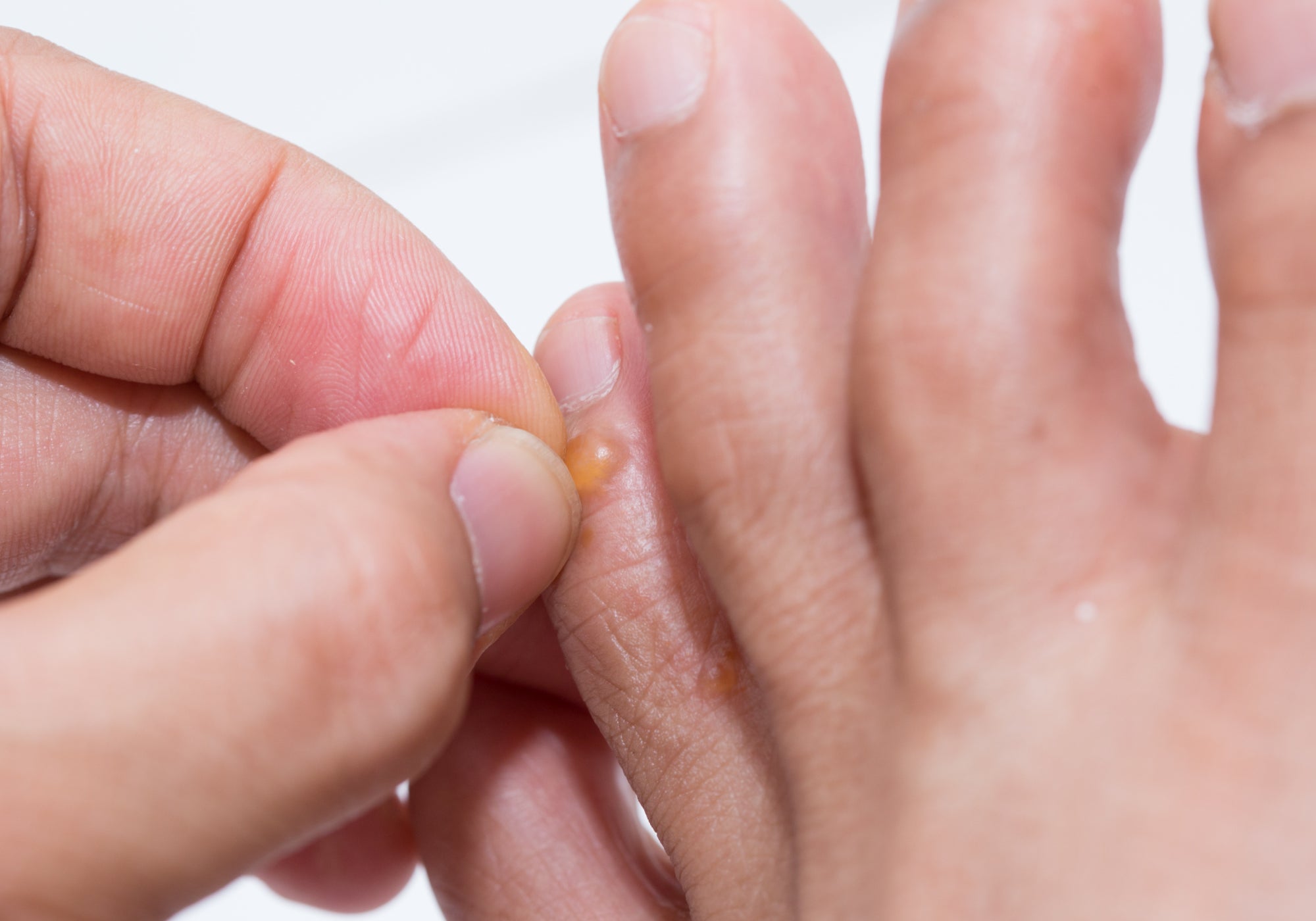 Is It OK To Pop Dyshidrotic Eczema?