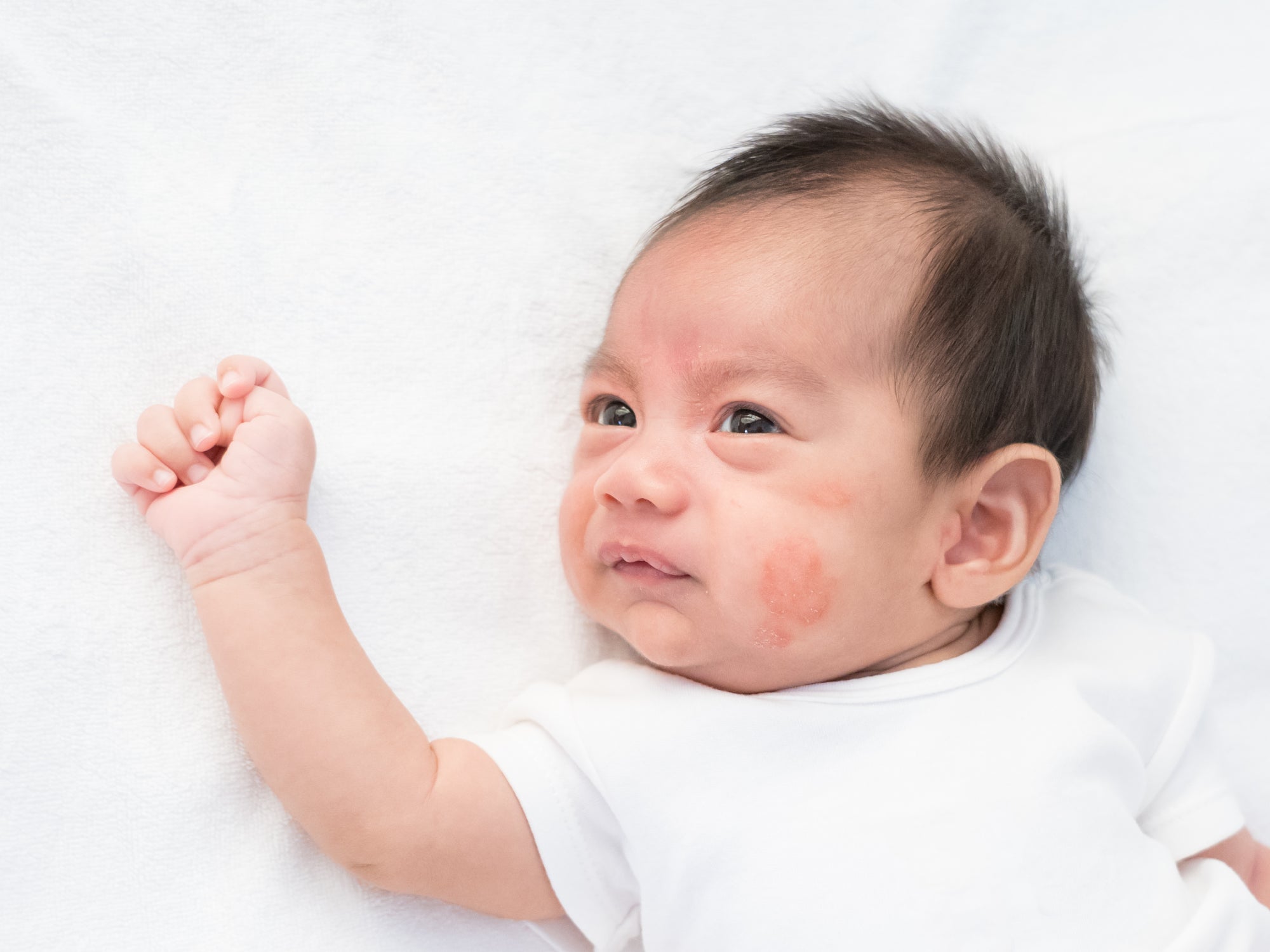 What Foods Trigger Eczema In Babies? – Balmonds