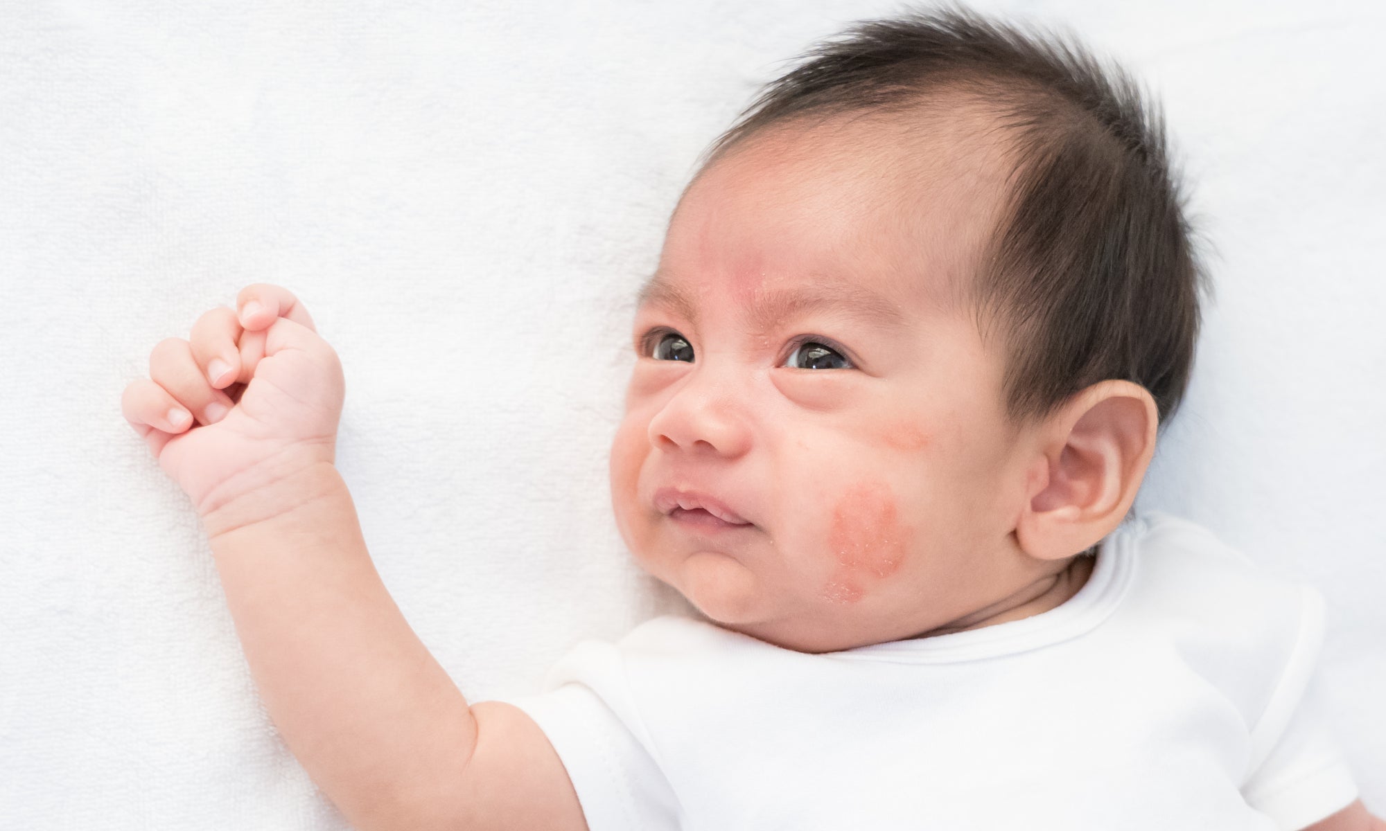 What Foods Trigger Eczema In Babies?