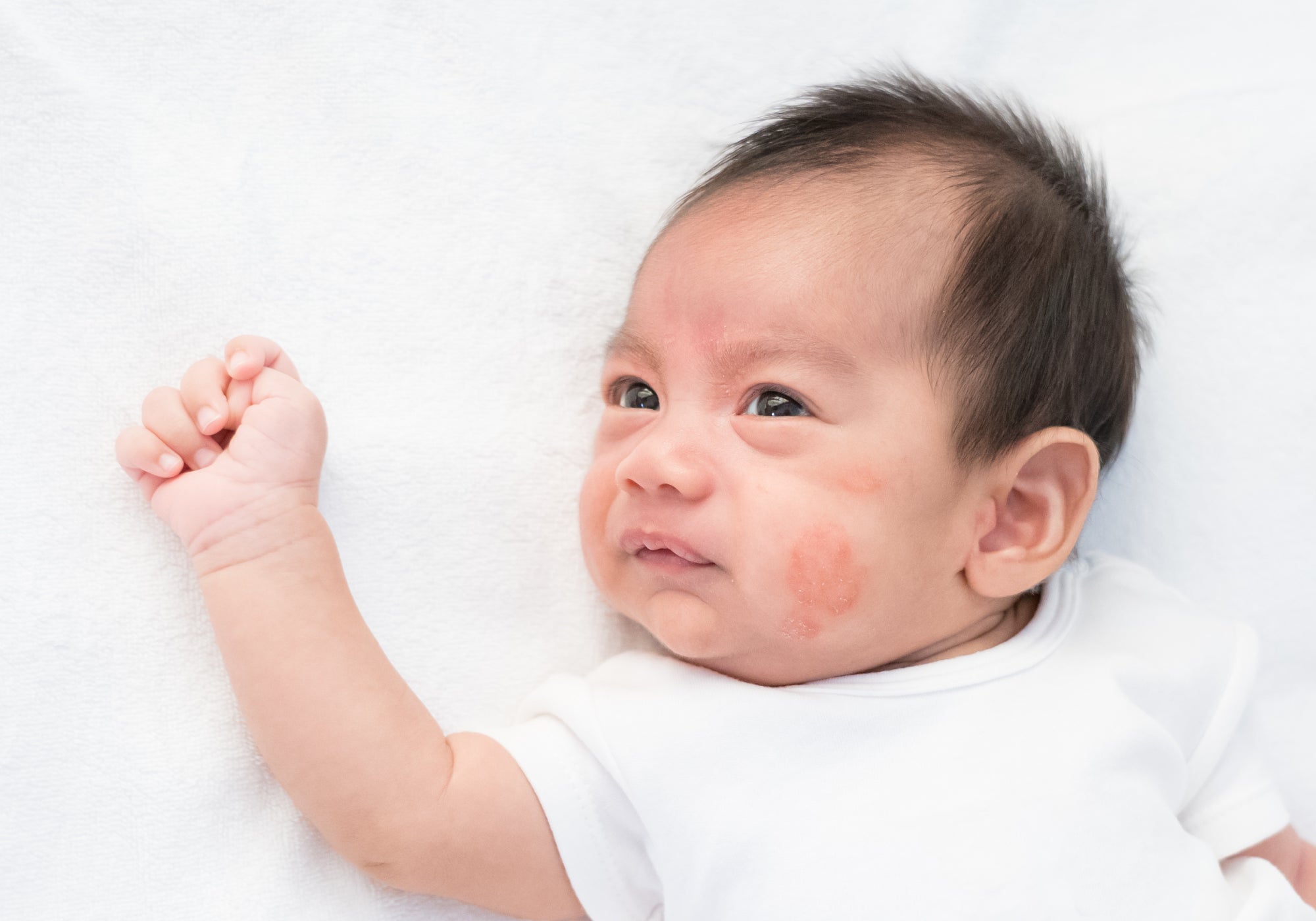 What Foods Trigger Eczema In Babies?
