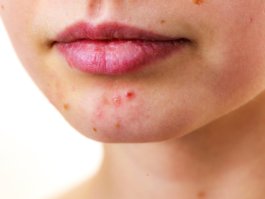 What Is It? Perioral Dermatitis Vs Acne