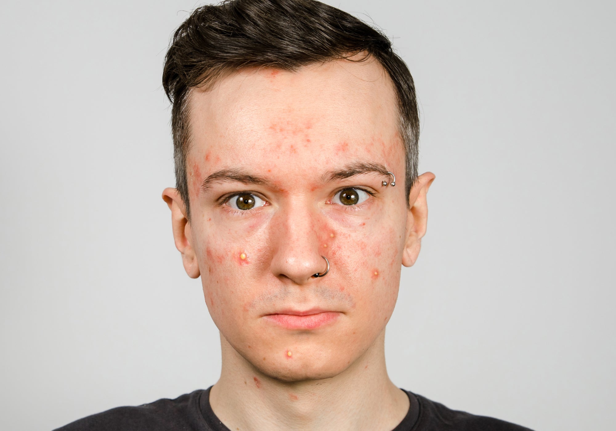 What Skin Infection Looks Like Acne?