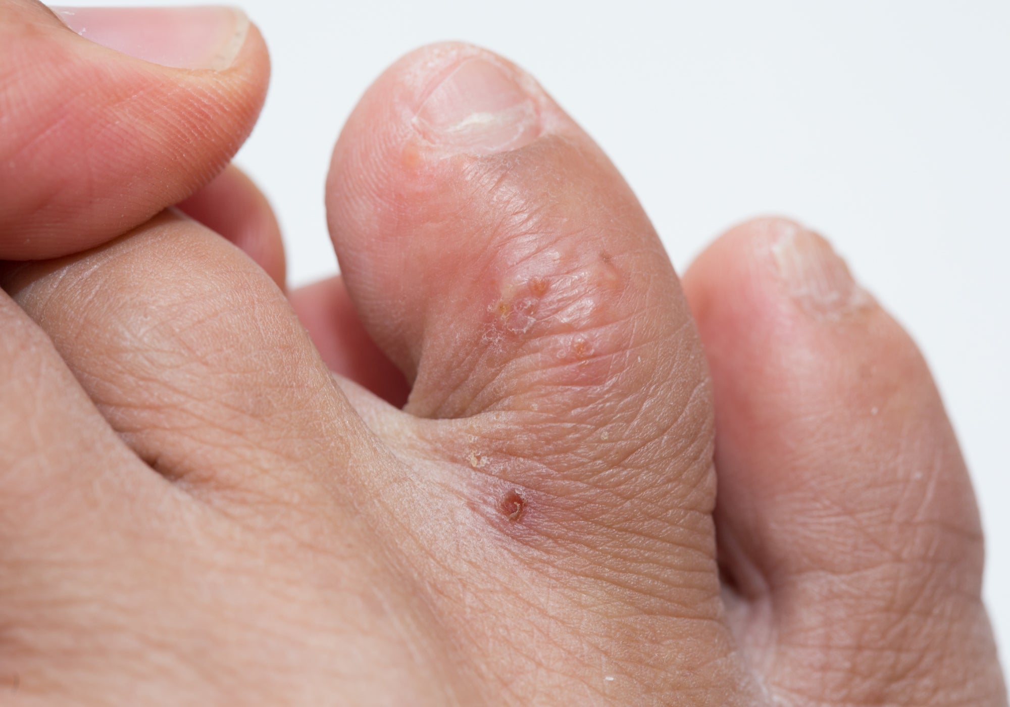 What Triggers Pompholyx?