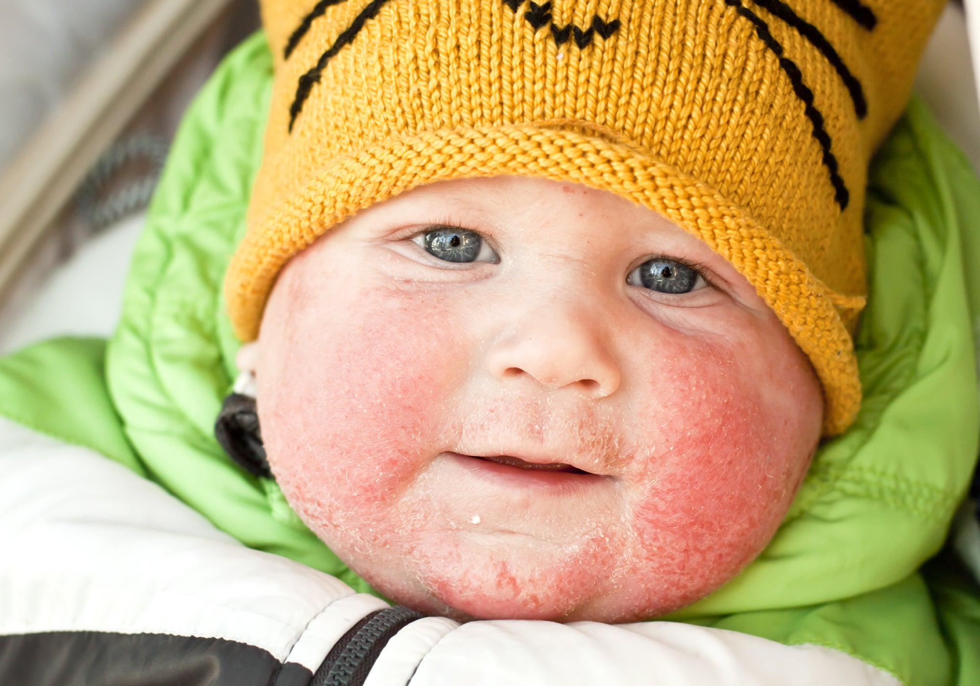 Does Baby Eczema Go Away?